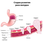 РАК ПЕЧЕНИ 1, 2, 3, 4 стадии степени Диагностика, лечение в Киеве